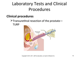 Copyright © 2014, 2011, 2007 by Saunders, an imprint of Elsevier Inc. 42
Laboratory Tests and Clinical
Procedures
Clinical procedures
Transurethral resection of the prostate—
TURP
 