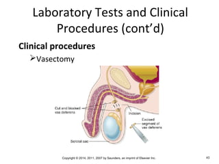 Copyright © 2014, 2011, 2007 by Saunders, an imprint of Elsevier Inc. 43
Laboratory Tests and Clinical
Procedures (cont’d)
Clinical procedures
Vasectomy
 