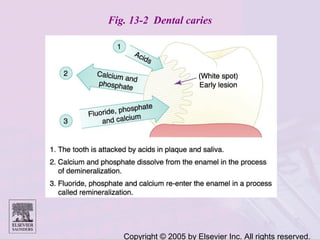 Copyright © 2005 by Elsevier Inc. All rights reserved.
Fig. 13-2 Dental caries
 