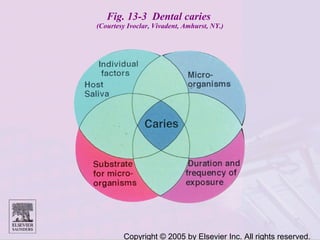 Copyright © 2005 by Elsevier Inc. All rights reserved.
Fig. 13-3 Dental caries
(Courtesy Ivoclar, Vivadent, Amhurst, NY.)
 