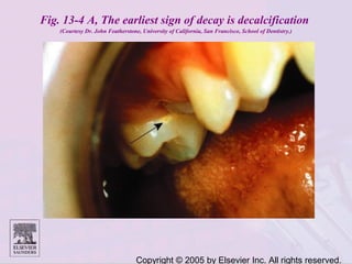 Copyright © 2005 by Elsevier Inc. All rights reserved.
Fig. 13-4 A, The earliest sign of decay is decalcification
(Courtesy Dr. John Featherstone, University of California, San Francisco, School of Dentistry.)
 