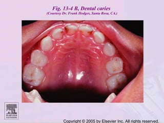 Copyright © 2005 by Elsevier Inc. All rights reserved.
Fig. 13-4 B, Dental caries
(Courtesy Dr. Frank Hodges, Santa Rosa, CA.)
 