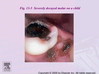 Copyright © 2005 by Elsevier Inc. All rights reserved.
Fig. 13-5 Severely decayed molar on a child
 