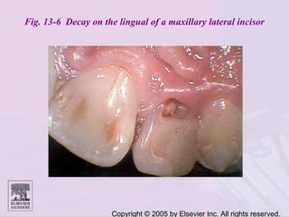 Copyright © 2005 by Elsevier Inc. All rights reserved.
Fig. 13-6 Decay on the lingual of a maxillary lateral incisor
 
