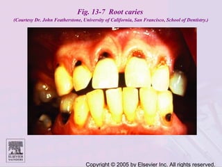 Copyright © 2005 by Elsevier Inc. All rights reserved.
Fig. 13-7 Root caries
(Courtesy Dr. John Featherstone, University of California, San Francisco, School of Dentistry.)
 