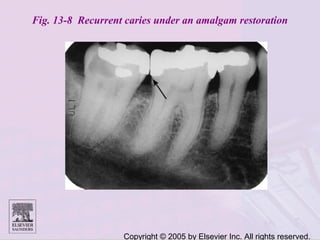 Copyright © 2005 by Elsevier Inc. All rights reserved.
Fig. 13-8 Recurrent caries under an amalgam restoration
 