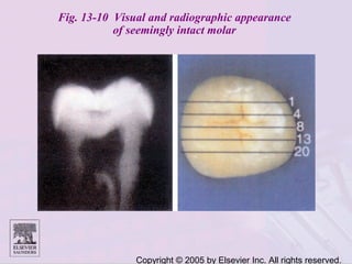 Copyright © 2005 by Elsevier Inc. All rights reserved.
Fig. 13-10 Visual and radiographic appearance
of seemingly intact molar
 