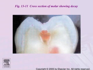 Copyright © 2005 by Elsevier Inc. All rights reserved.
Fig. 13-11 Cross section of molar showing decay
 