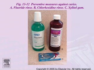 Copyright © 2005 by Elsevier Inc. All rights reserved.
Fig. 13-12 Preventive measures against caries.
A, Fluoride rinse. B, Chlorhexidine rinse. C, Xylitol gum.
 