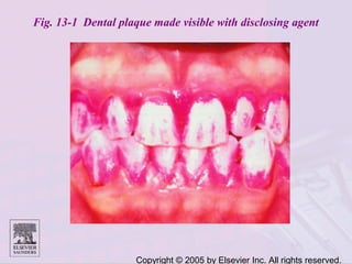 Copyright © 2005 by Elsevier Inc. All rights reserved.
Fig. 13-1 Dental plaque made visible with disclosing agent
 
