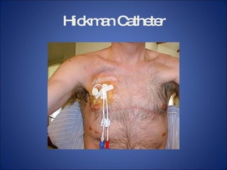 Image Hickman Process Chapter 015 infusion therapy | PPT