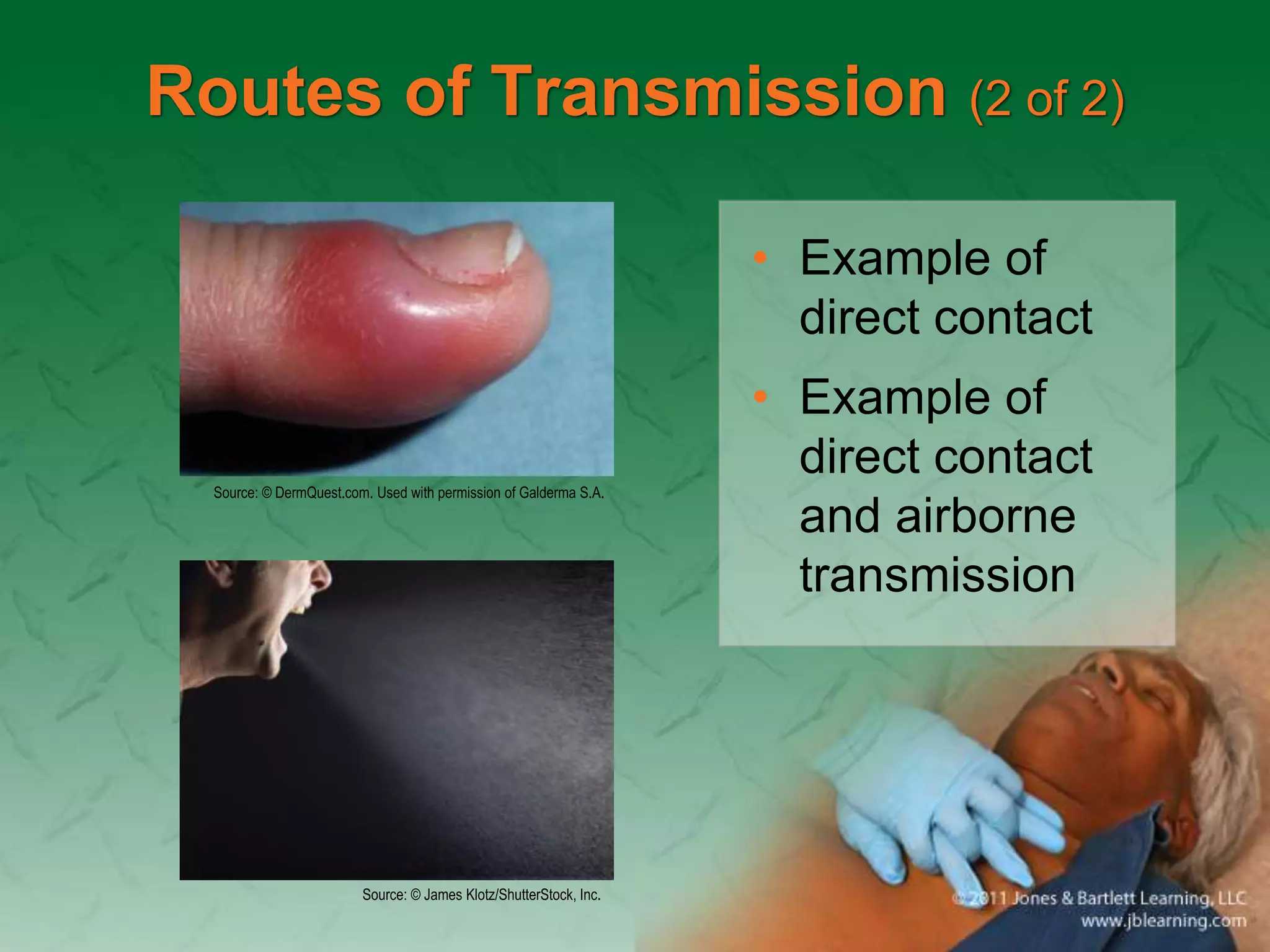 Routes of Transmission (2 of 2)
• Example of
direct contact
• Example of
direct contact
and airborne
transmission
Source: © DermQuest.com. Used with permission of Galderma S.A.
Source: © James Klotz/ShutterStock, Inc.
 