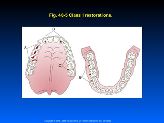 Fig. 48-5 Class I restorations.

Copyright © 2009, 2006 by Saunders, an imprint of Elsevier Inc. All rights

 