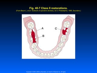 Fig. 48-7 Class II restorations.
(From Baum L, et al: Textbook of operative dentistry, ed 3, Philadelphia, 1995, Saunders.)
dentistry,

Copyright © 2009, 2006 by Saunders, an imprint of Elsevier Inc. All rights

 