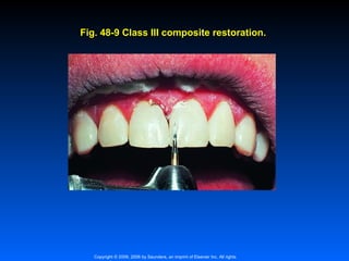 Fig. 48-9 Class III composite restoration.

Copyright © 2009, 2006 by Saunders, an imprint of Elsevier Inc. All rights

 