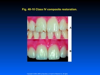 Fig. 48-10 Class IV composite restoration.

Copyright © 2009, 2006 by Saunders, an imprint of Elsevier Inc. All rights

 