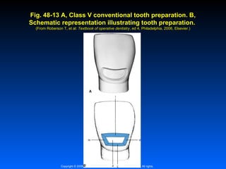 Fig. 48-13 A, Class V conventional tooth preparation. B,
Schematic representation illustrating tooth preparation.
(From Roberson T, et al: Textbook of operative dentistry, ed 4, Philadelphia, 2006, Elsevier.)
dentistry,

Copyright © 2009, 2006 by Saunders, an imprint of Elsevier Inc. All rights

 