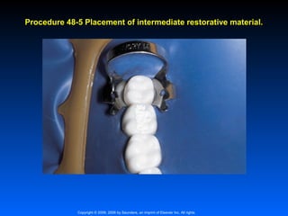 Procedure 48-5 Placement of intermediate restorative material.

Copyright © 2009, 2006 by Saunders, an imprint of Elsevier Inc. All rights

 