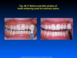 Fig. 48-17 Before-and-after photos of
tooth whitening used for extrinsic stains.

Copyright © 2009, 2006 by Saunders, an imprint of Elsevier Inc. All rights

 