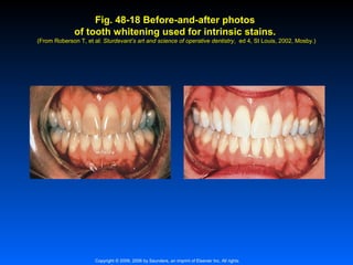 Fig. 48-18 Before-and-after photos
of tooth whitening used for intrinsic stains.
(From Roberson T, et al: Sturdevant’s art and science of operative dentistry, ed 4, St Louis, 2002, Mosby.)
dentistry,

Copyright © 2009, 2006 by Saunders, an imprint of Elsevier Inc. All rights

 