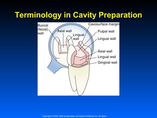Terminology in Cavity Preparation

Copyright © 2009, 2006 by Saunders, an imprint of Elsevier Inc. All rights

 