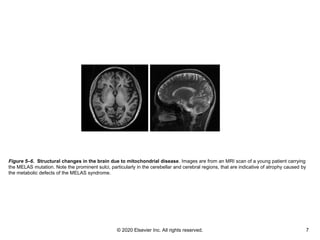 © 2020 Elsevier Inc. All rights reserved. 7
Figure 5–6. Structural changes in the brain due to mitochondrial disease. Images are from an MRI scan of a young patient carrying
the MELAS mutation. Note the prominent sulci, particularly in the cerebellar and cerebral regions, that are indicative of atrophy caused by
the metabolic defects of the MELAS syndrome.
 