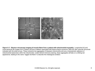© 2020 Elsevier Inc. All rights reserved. 8
Figure 5–7. Electron microscopy imaging of muscle fibers from a patient with mitochondrial myopathy. Longitudinal (A) and
cross-sectional (B) images from a patient carrying a deletion associated with Kearns-Sayre syndrome. Note the dark, granular structures
indicated with the white arrows. These inclusions are aggregates of diseased mitochondria and are a characteristic signature of
mitochondrial dysfunction within the mitochondria. Under Gömöri trichrome staining, these aggregates will take on a striking red
appearance, leading to the name “ragged red fibers” to describe this histological condition.
 