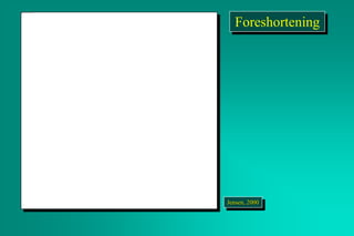 Foreshortening
Jensen, 2000
 