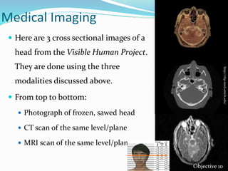 Medical Imaging
 Here are 3 cross sectional images of a
head from the Visible Human Project.
They are done using the three
modalities discussed above.
 From top to bottom:
 Photograph of frozen, sawed head
 CT scan of the same level/plane
 MRI scan of the same level/plane
http://vhp.med.umich.edu/
Objective 10
 