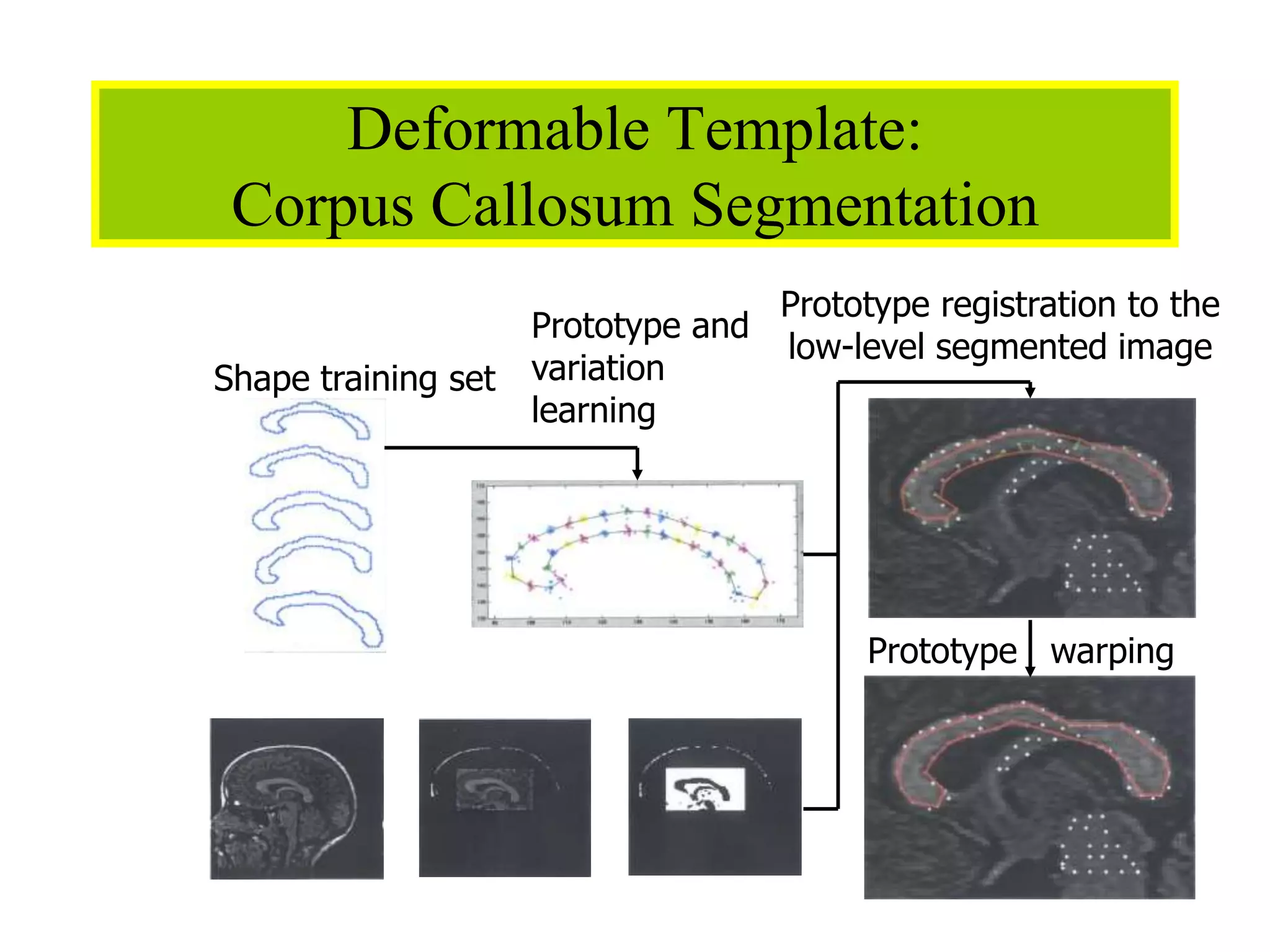 13
Deformable Template:
Corpus Callosum Segmentation
Prototype registration to the
low-level segmented image
Shape training set
Prototype and
variation
learning
Prototype warping
 