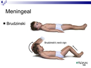 Meningeal Brudzinski 