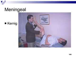 Meningeal Kernig 
