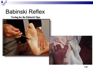 Babinski Reflex 