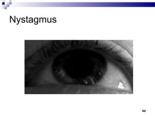 Nystagmus  