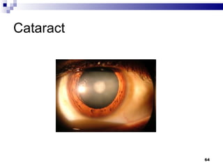 Cataract  