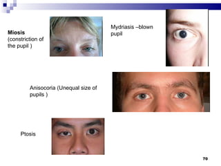 Mydriasis –blown pupil Miosis  (constriction of the pupil ) Anisocoria (Unequal size of pupils ) Ptosis 