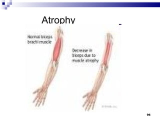   Atrophy 
