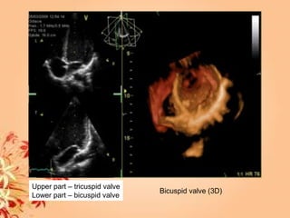 Bicuspid valve (3D)
Upper part – tricuspid valve
Lower part – bicuspid valve
 