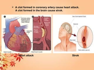  A clot formed in coronary artery cause heart attack.
A clot formed in the brain cause strok.
Heart attack Strok
 