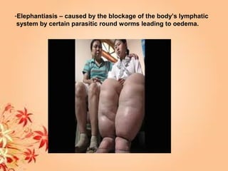 -Elephantiasis – caused by the blockage of the body’s lymphatic
system by certain parasitic round worms leading to oedema.
 
