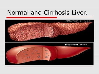 Normal and Cirrhosis Liver.
 