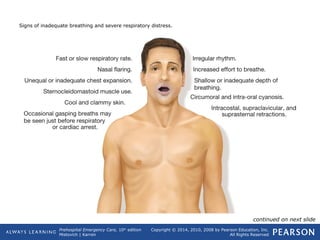 Prehospital Emergency Care, 10th
edition
Mistovich | Karren
Copyright © 2014, 2010, 2008 by Pearson Education, Inc.
All Rights Reserved
Signs of inadequate breathing and severe respiratory distress.
continued on next slide
 