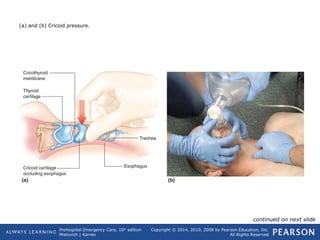 Prehospital Emergency Care, 10th
edition
Mistovich | Karren
Copyright © 2014, 2010, 2008 by Pearson Education, Inc.
All Rights Reserved
(a) and (b) Cricoid pressure.
continued on next slide
 