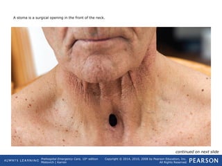 Prehospital Emergency Care, 10th
edition
Mistovich | Karren
Copyright © 2014, 2010, 2008 by Pearson Education, Inc.
All Rights Reserved
A stoma is a surgical opening in the front of the neck.
continued on next slide
 