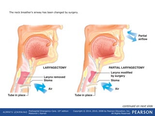 Prehospital Emergency Care, 10th
edition
Mistovich | Karren
Copyright © 2014, 2010, 2008 by Pearson Education, Inc.
All Rights Reserved
The neck breather's airway has been changed by surgery.
continued on next slide
 