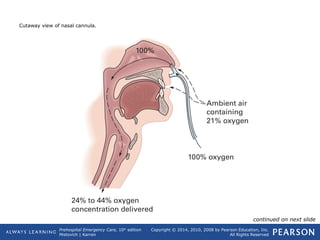 Prehospital Emergency Care, 10th
edition
Mistovich | Karren
Copyright © 2014, 2010, 2008 by Pearson Education, Inc.
All Rights Reserved
Cutaway view of nasal cannula.
continued on next slide
 