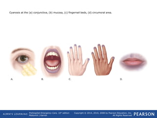 Prehospital Emergency Care, 10th
edition
Mistovich | Karren
Copyright © 2014, 2010, 2008 by Pearson Education, Inc.
All Rights Reserved
Cyanosis at the (a) conjunctiva, (b) mucosa, (c) fingernail beds, (d) circumoral area.
 