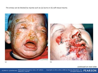 Prehospital Emergency Care, 10th
edition
Mistovich | Karren
Copyright © 2014, 2010, 2008 by Pearson Education, Inc.
All Rights Reserved
The airway can be blocked by injuries such as (a) burns or (b) soft tissue trauma.
continued on next slide
 