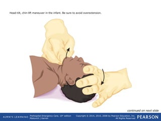 Prehospital Emergency Care, 10th
edition
Mistovich | Karren
Copyright © 2014, 2010, 2008 by Pearson Education, Inc.
All Rights Reserved
Head-tilt, chin-lift maneuver in the infant. Be sure to avoid overextension.
continued on next slide
 