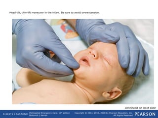Prehospital Emergency Care, 10th
edition
Mistovich | Karren
Copyright © 2014, 2010, 2008 by Pearson Education, Inc.
All Rights Reserved
Head-tilt, chin-lift maneuver in the infant. Be sure to avoid overextension.
continued on next slide
 